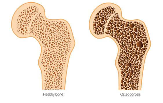 Low Bone Mineral Density Symptoms